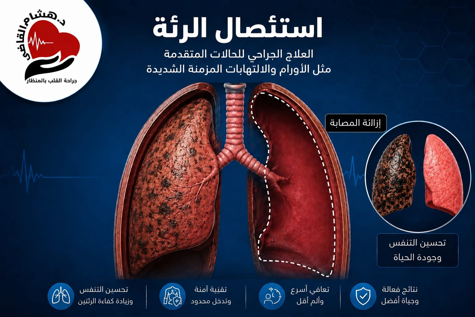 عملية استئصال الرئة جزئي وكلي بالمنظار