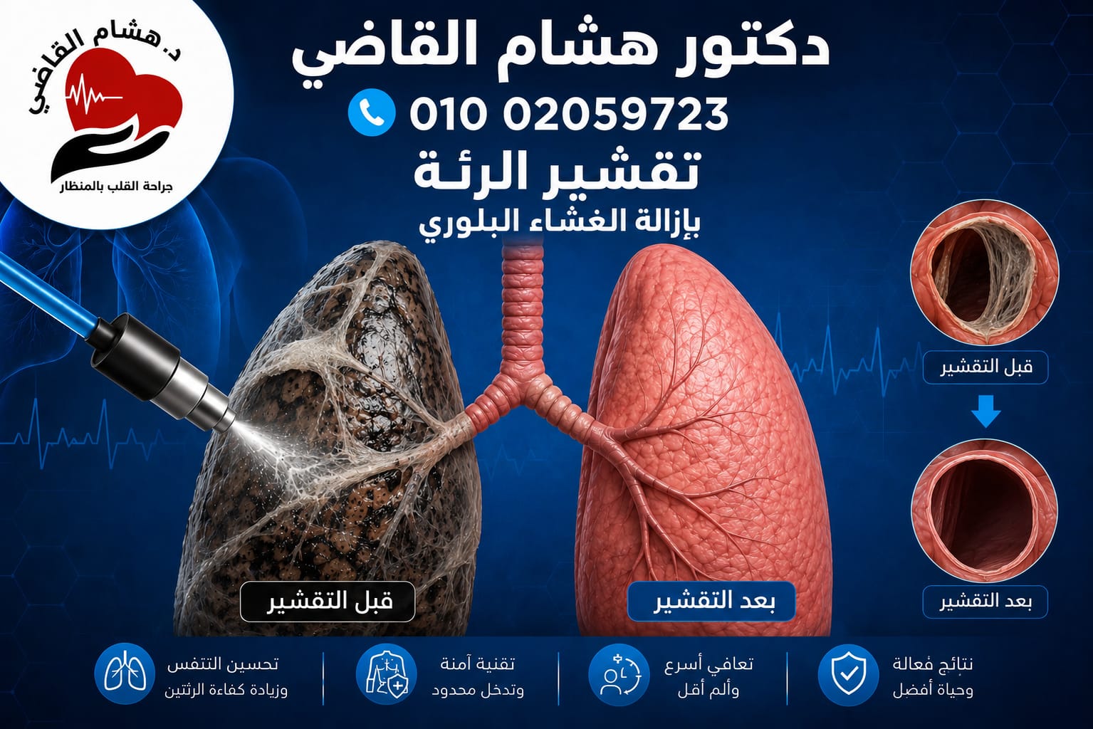عملية تقشير الرئة والغشاء البلوري بالمنظار